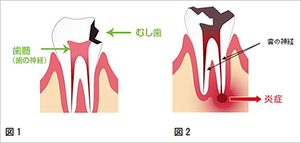 精密根管治療 | 名古屋の歯周病専門医さぶり歯科
