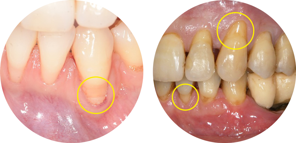 歯肉 退縮 と は