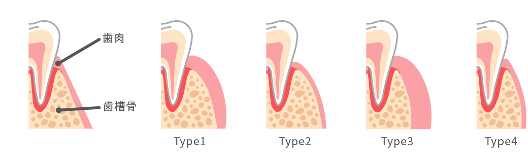 Maynard Classification