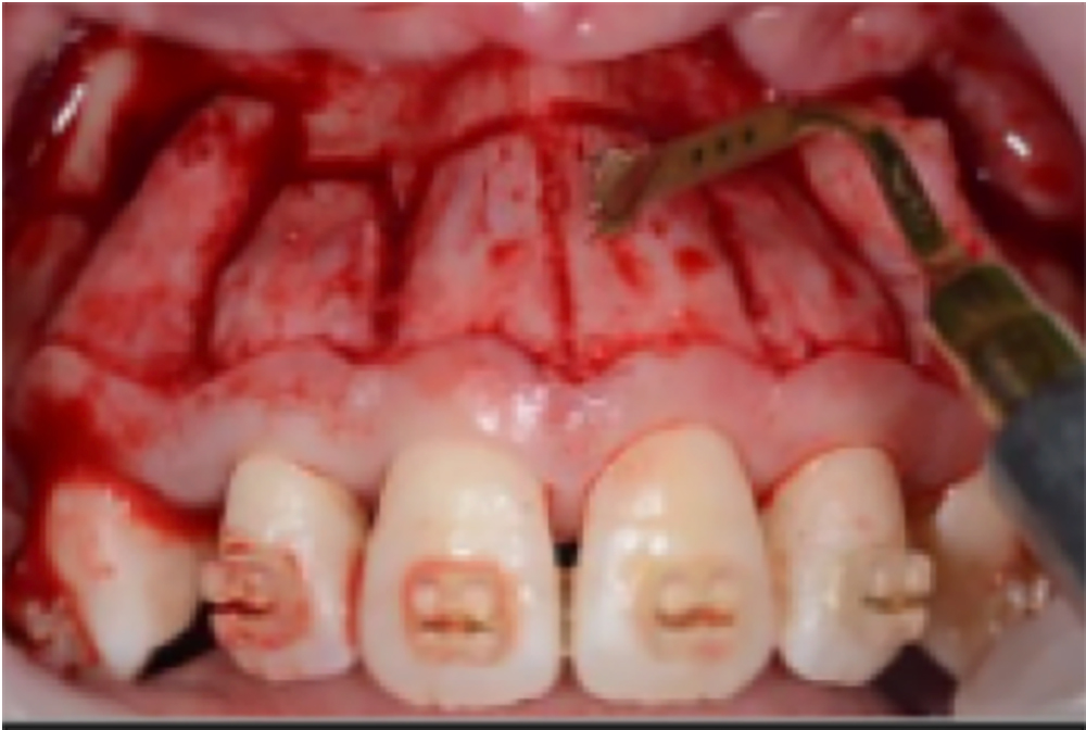歯を支える骨に対して外科処置（傷をつけます・穴を作ります）を施すPAOO法