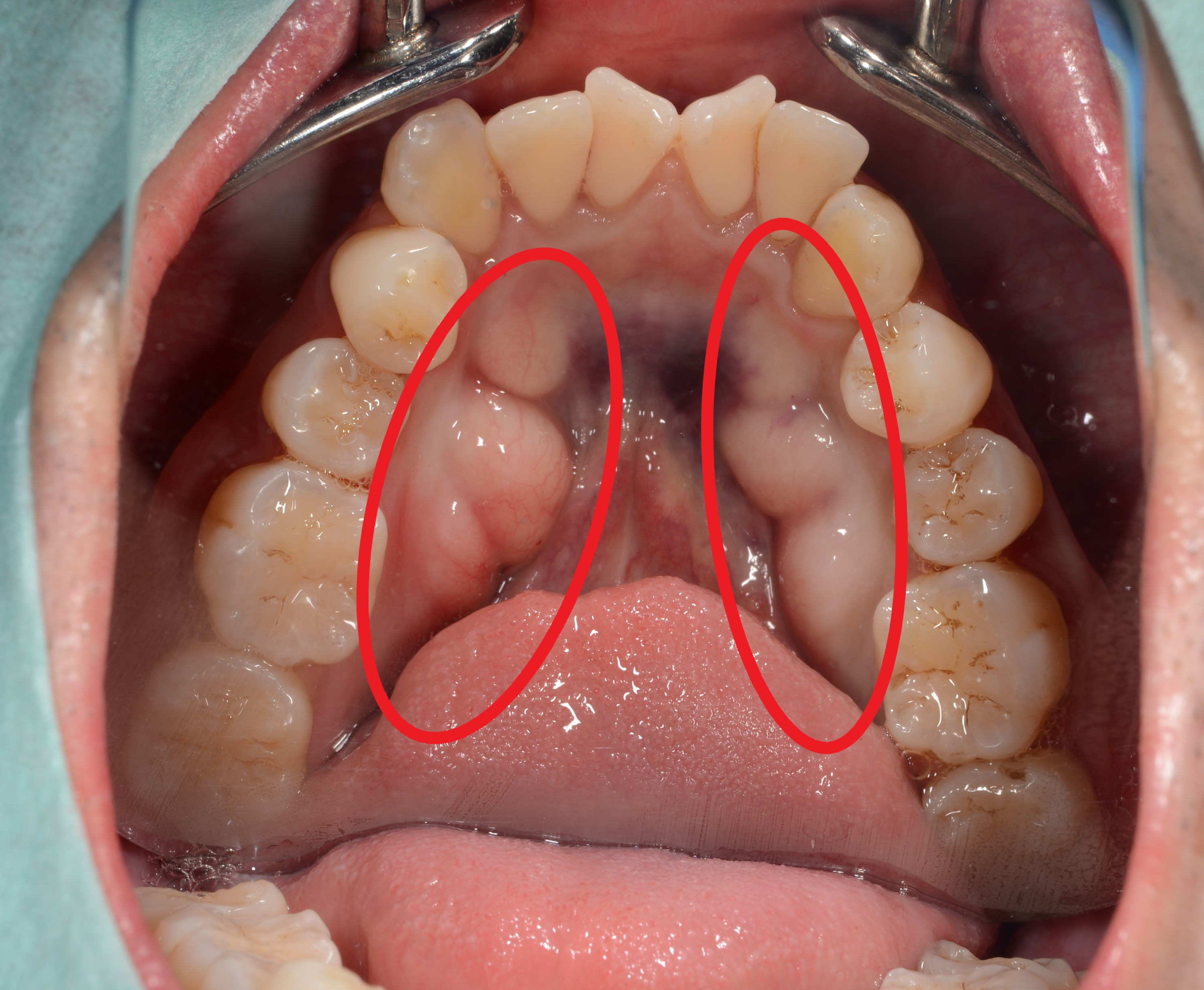 外骨症とは 名古屋の歯周病専門医さぶり歯科