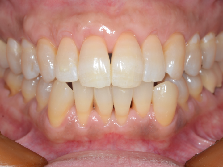 歯肉退縮の原因