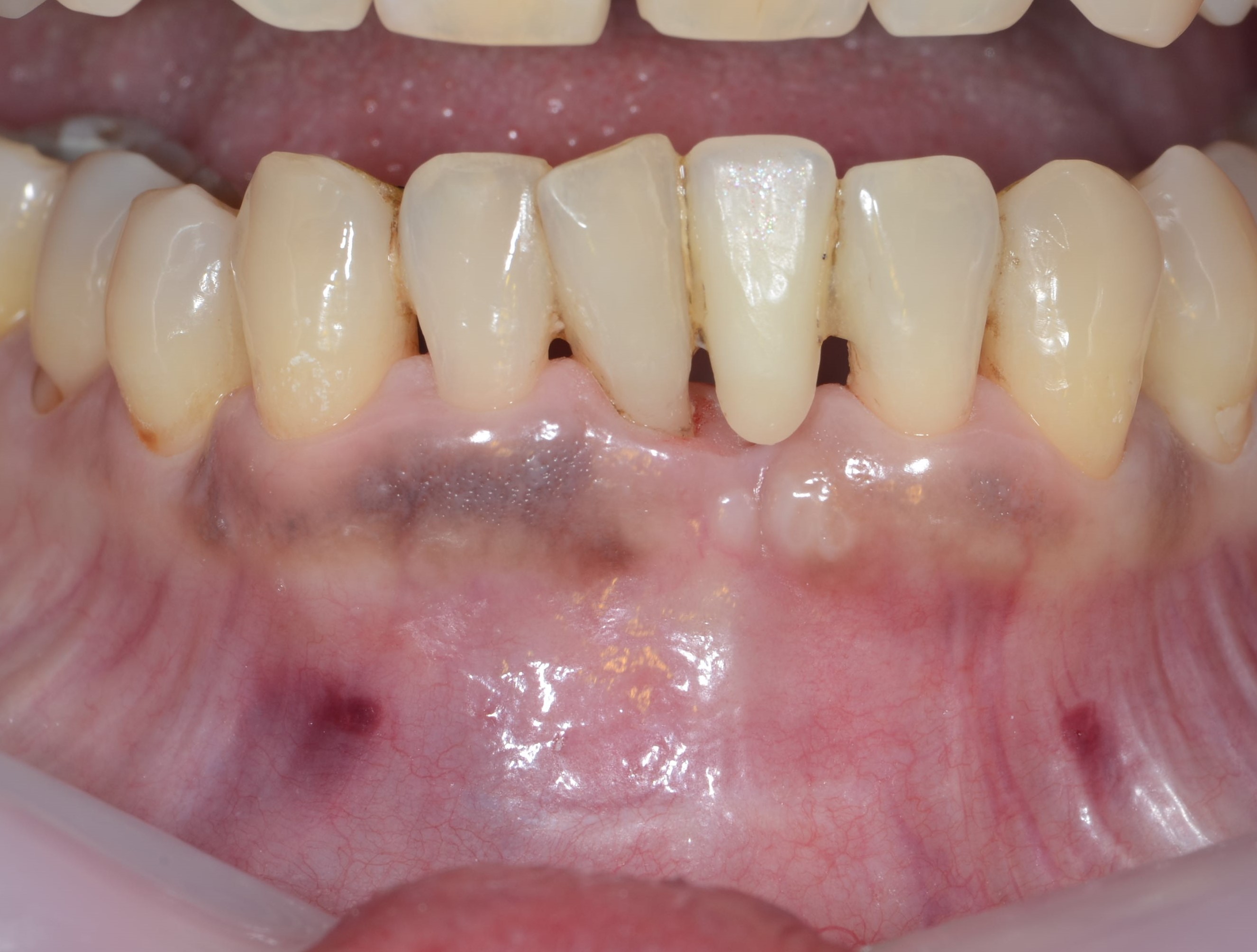 歯周組織再生療法とは？ | 名古屋の歯周病専門医さぶり歯科