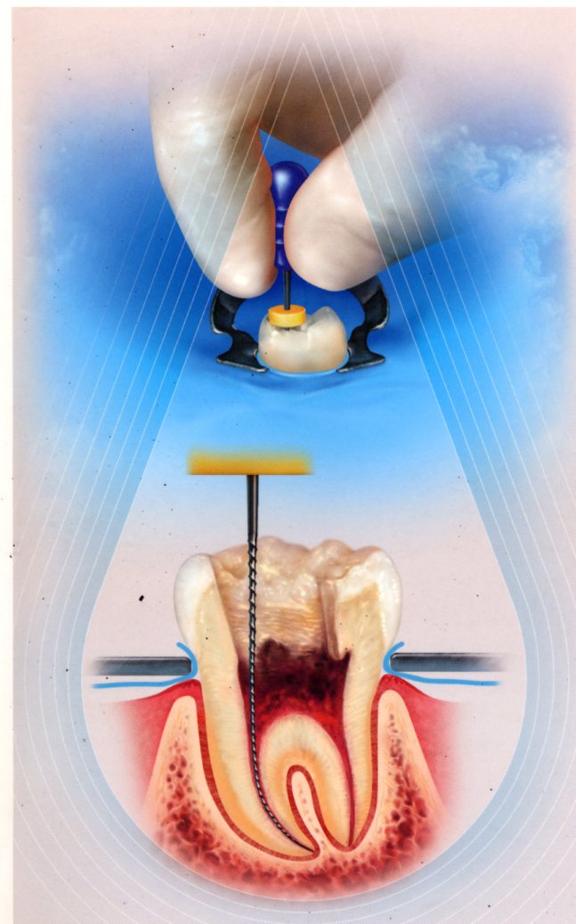 中古品】 根管治療セット 製品詳細「ルートZX3」 | フォルディネット